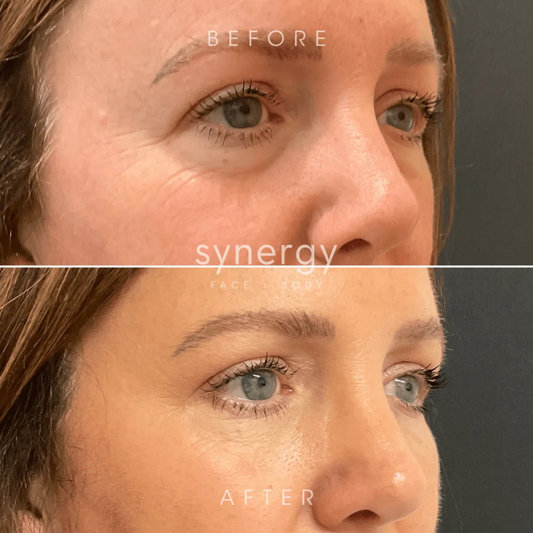 What Is Restylane? How It Works, What It Treats, and How Long Results Last