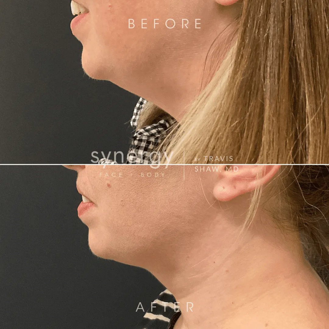 Kybella Side Effects: What to Expect and How Long They Last