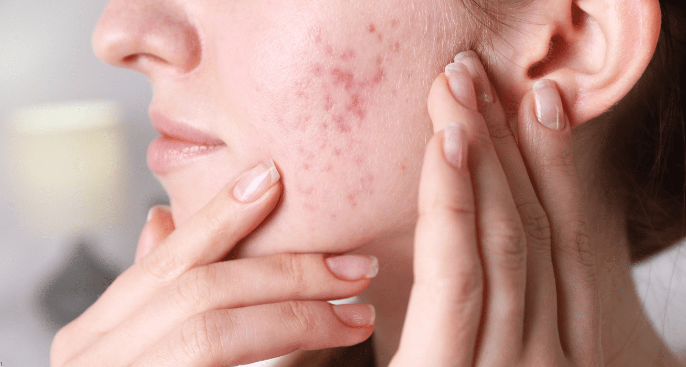 Acne / Acne Scarring