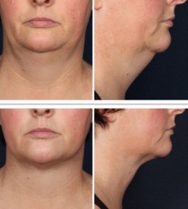 kybella before and after image of a woman's chin