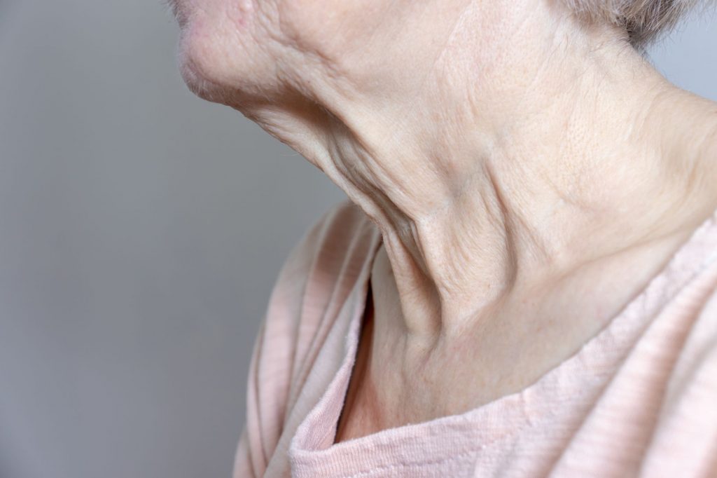 Loose skin along a woman's neck