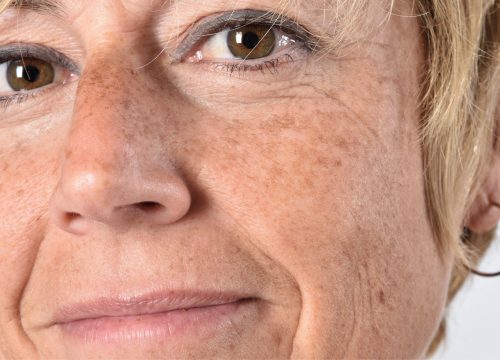 Middle-aged woman with age spots on her face