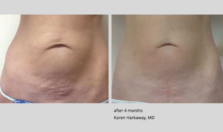 Before and after photos for thermitight by Karen Harkaway, MD