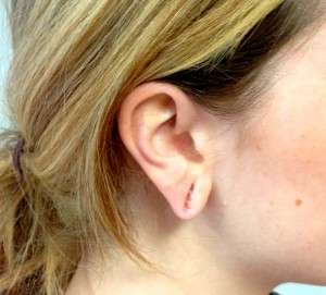 gauged ear before surgery