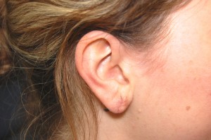 gauged ear after surgery