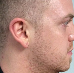 patient with gauged ears after surgery