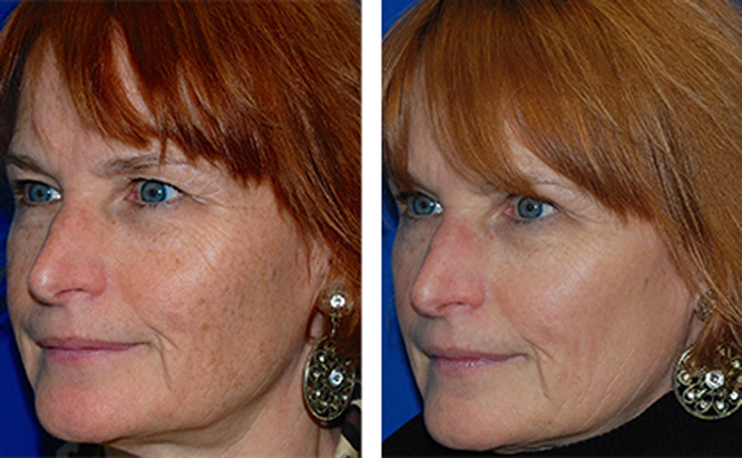 IPL before and after results for older female patient