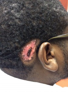 after keloid removal