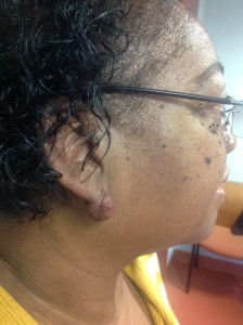 keloid removal from a woman's ear, pre treatment.