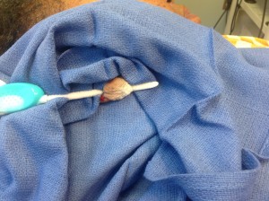 keloid removal from ear, during procedure