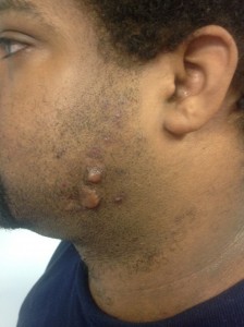 keloids on a patient's face before cryoshape treatment