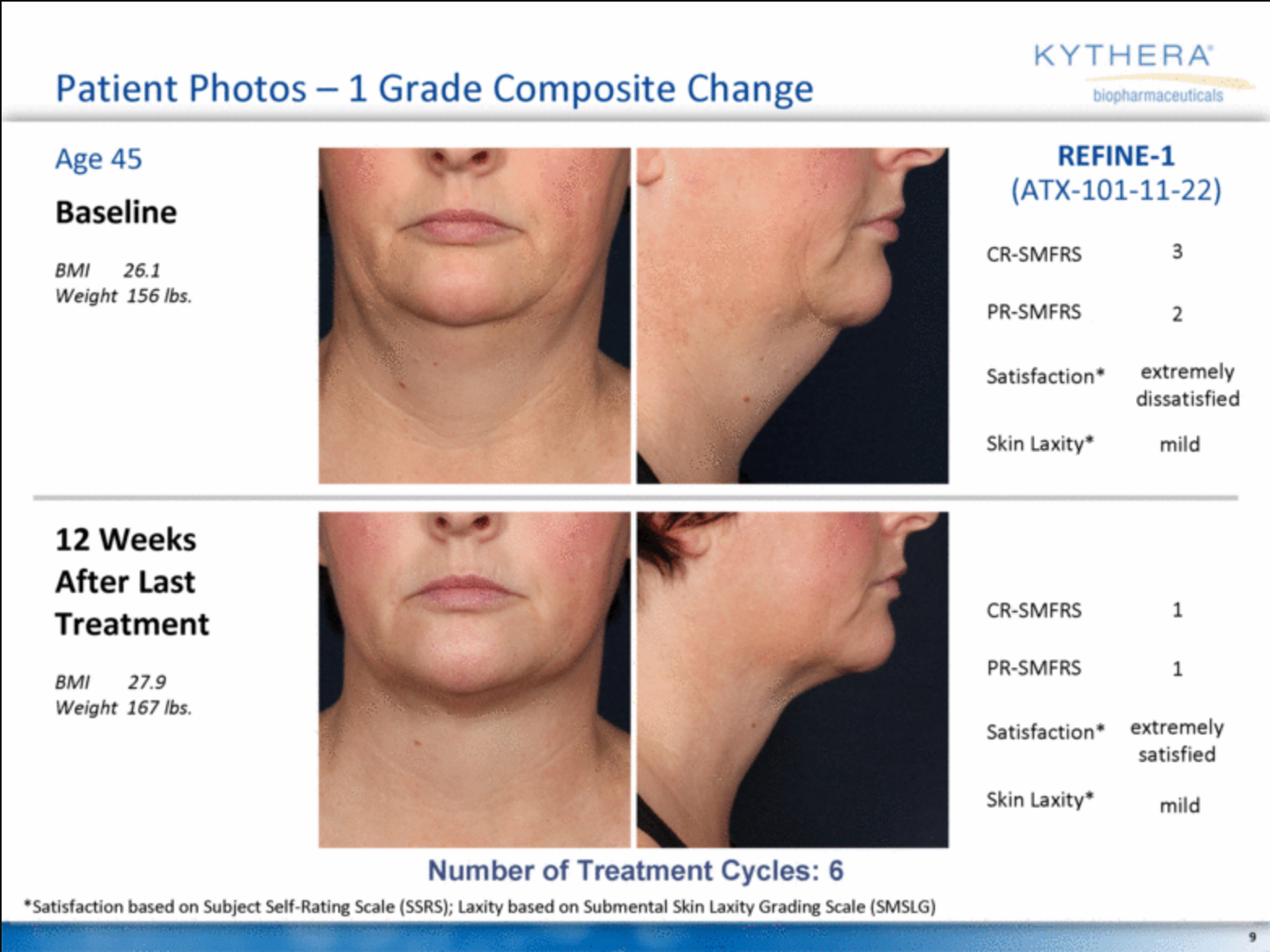 Using Kybella for Fat Reduction | Richmond, VA | Travis Shaw, MD