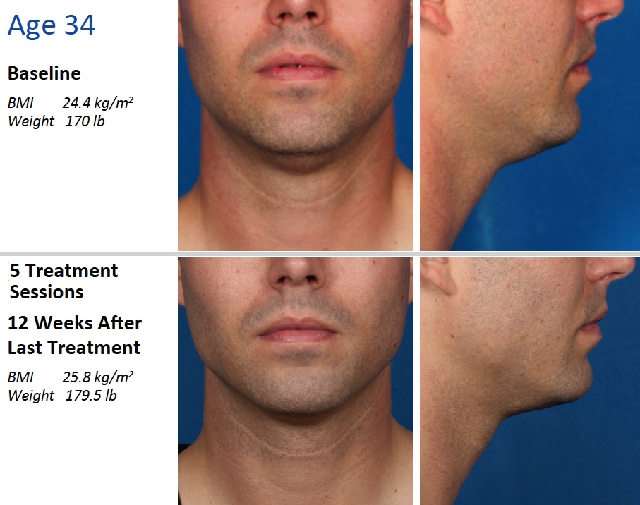 kybella injection before and after photos of 34 year old male