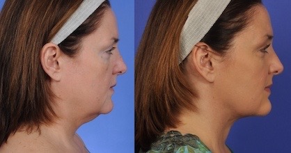 non-surgical skin tightening before and after image