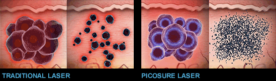 Picosure laser and traditional laser tattoo removal comparison photo