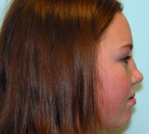 girl with injured nose before rhinoplasty surgery