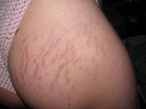purple stretch marks on the inner thigh