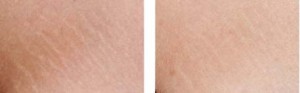 Stretch mark removal before and after photos