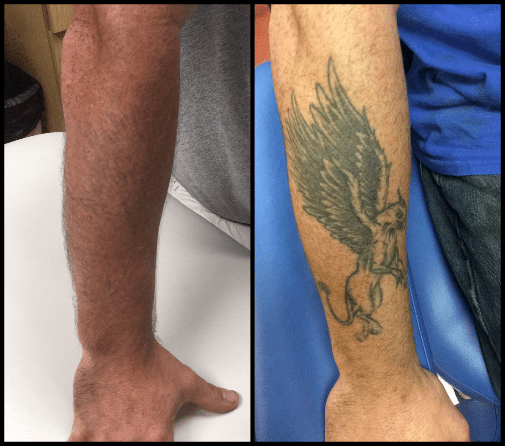 griffin tattoo removal before and after photo