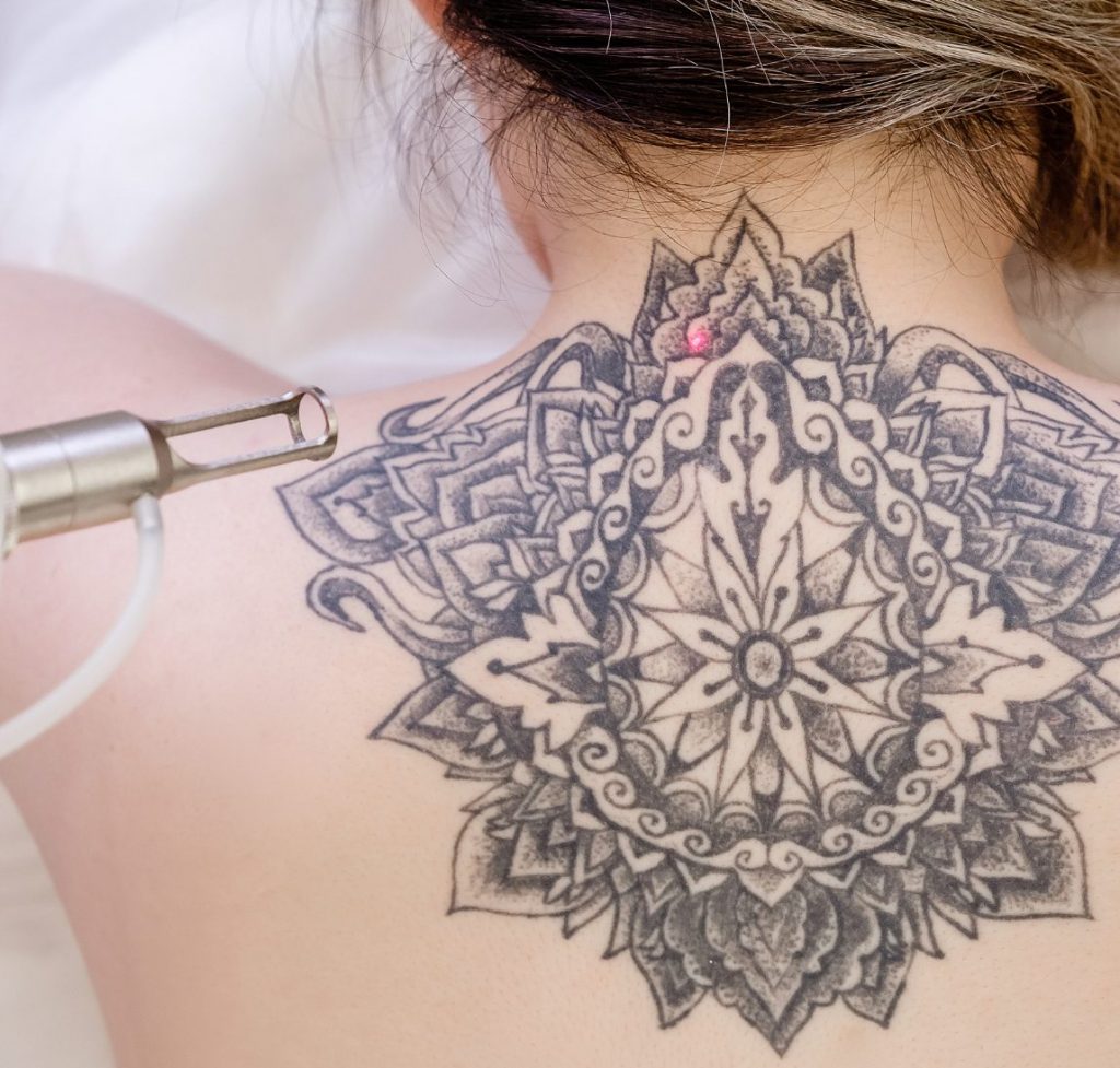 Woman getting laser tattoo removal done