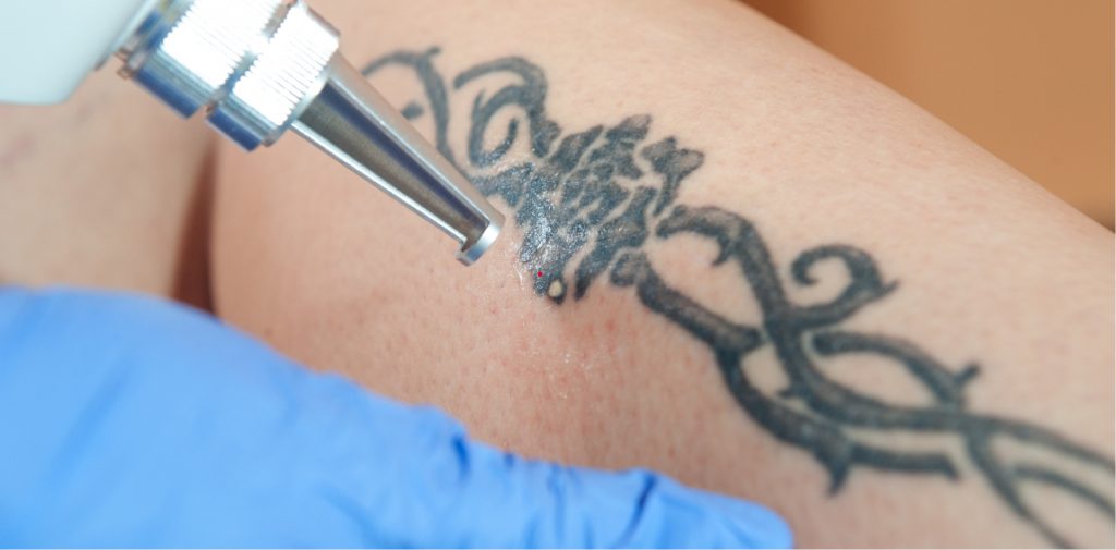laser demostration of removing unwanted tattoos
