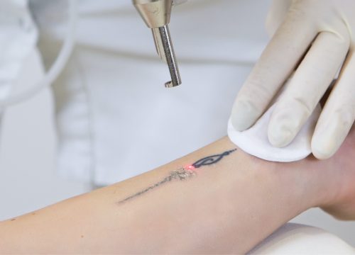 Unwanted tattoos being removed by a laser