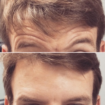 Before and after forehead line results